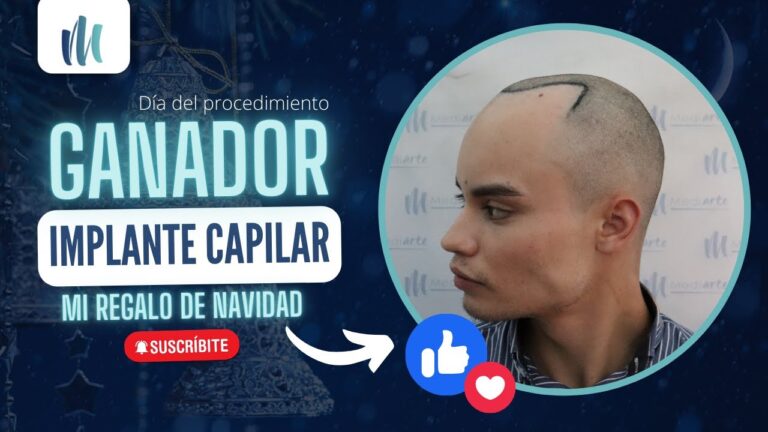 Estrategias Efectivas para la P&eacute;rdida de Cabello en Trasplantes Capilares