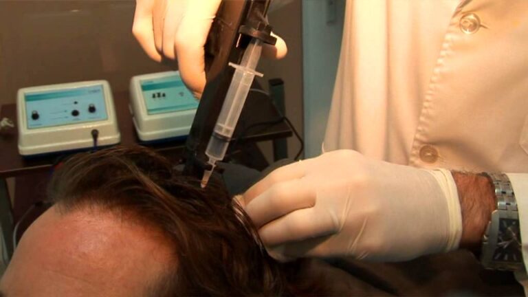 Avances en Tratamientos Capilares con L&aacute;ser