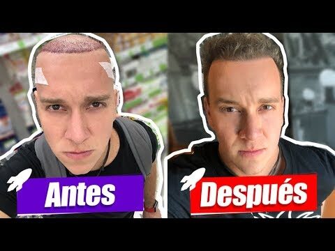 Efectividad de los Microinjertos en Tratamientos Capilares